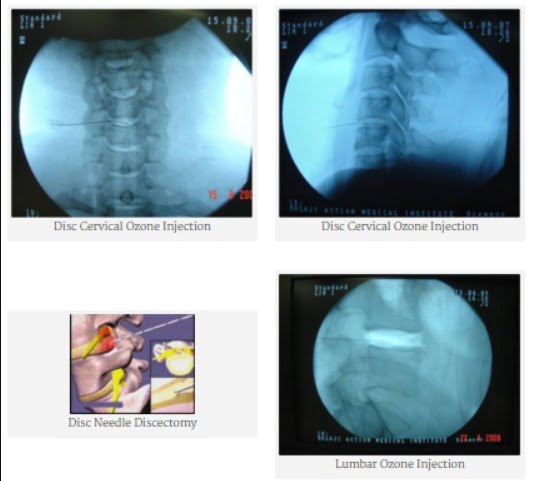 Slip Disc & Sciatica - Spine Disc & Pain Specialist - Dr. Neeraj Jain,  Ozone Disc Treatment